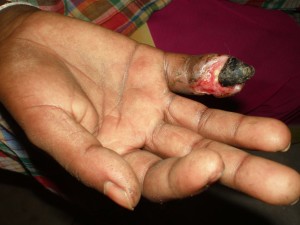 Effects of snake bite on finger